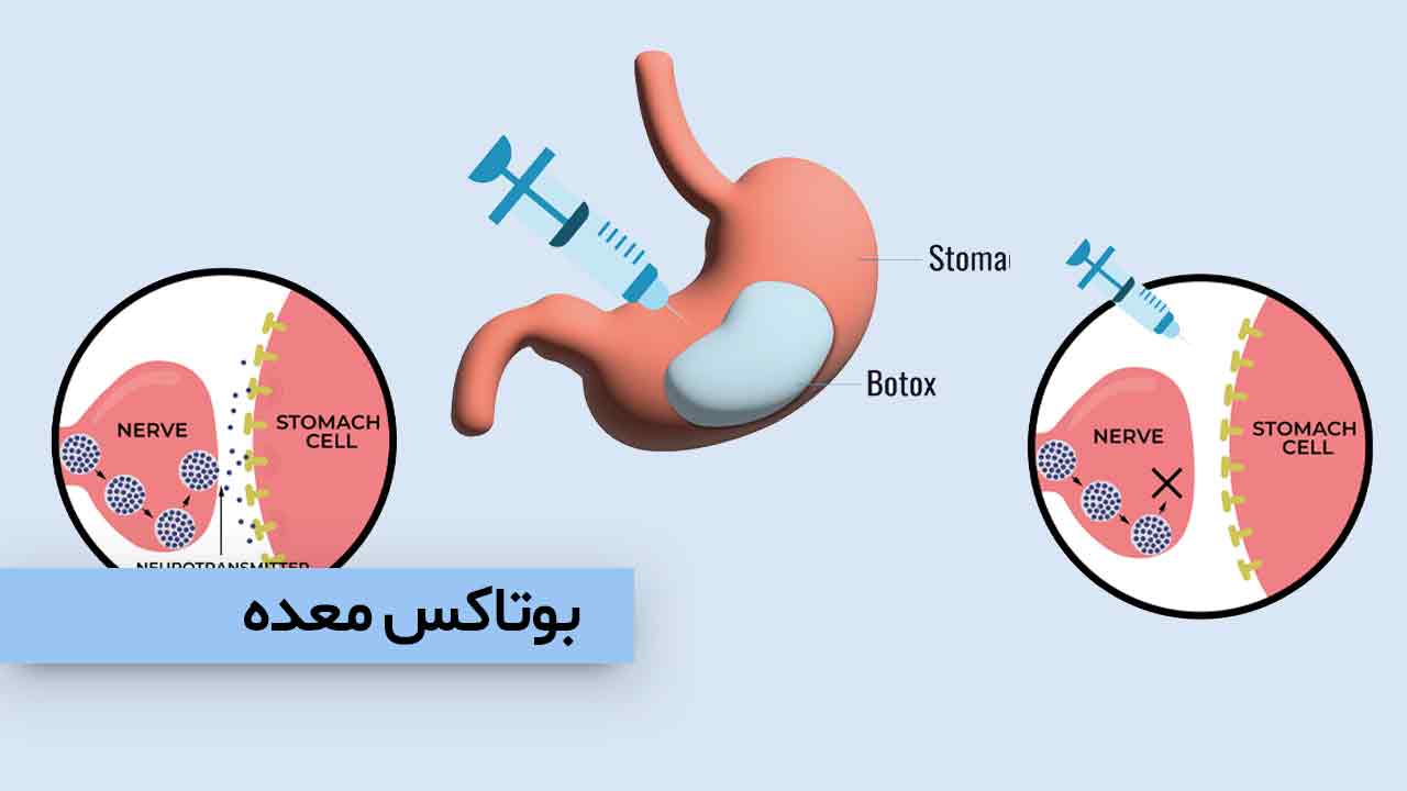 بوتاکس معده