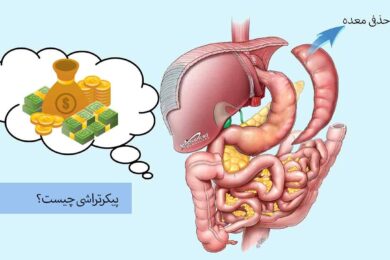 هزینه اسلیو معده